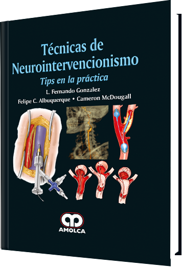 Técnicas de Neurointervencionismo