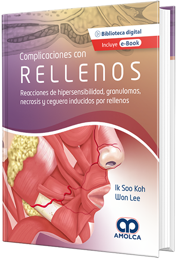 Complicaciones con Rellenos. Reacciones de hipersensibilidad, granulomas, necrosis y ceguera inducidos por rellenos