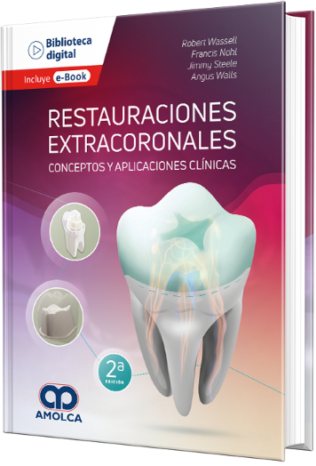Restauraciones Extracoronales. Conceptos y Aplicaciones Clínicas
